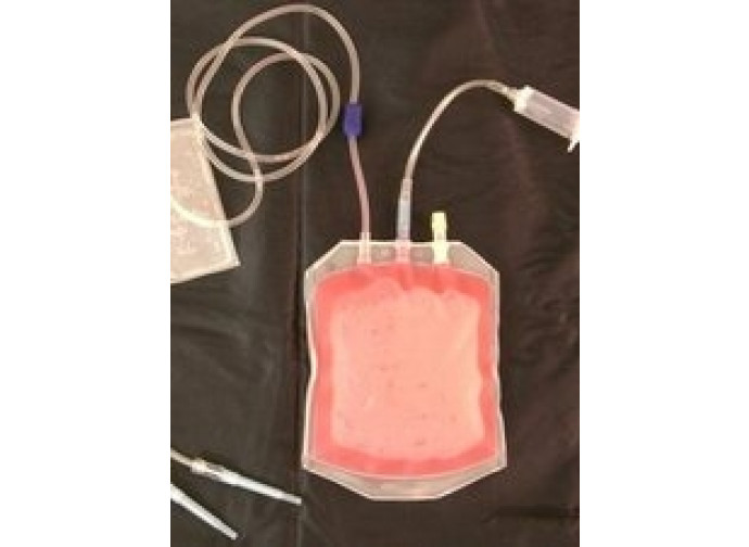 sangue da cordone ombelicale sangue da cordone ombelicale